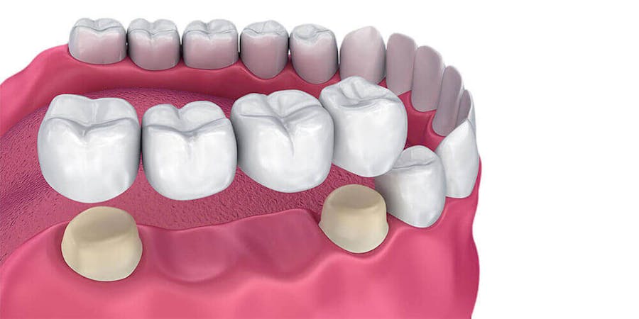 Dental Bridges Ajax
